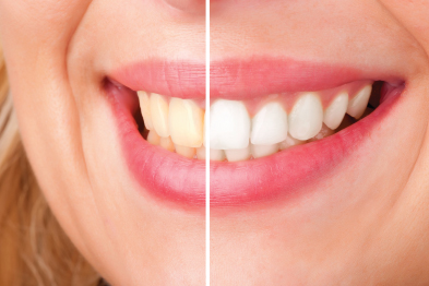 Does Teeth Whitening Damage Your Enamel
