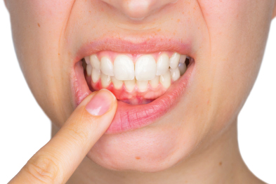 A Healthy Smile: Preventing Tooth Decay and Gum Disease