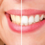 Does Teeth Whitening Damage Your Enamel