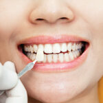 LATEST TREND IN DENTAL IMPLANTS 2024