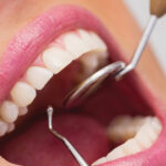 WHAT NOT TO DO BEFORE ROOT CANAL TREATMENTS