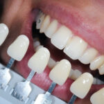 What Is Tooth-Colored Fillings? How Do Tooth-Colored Fillings Work?