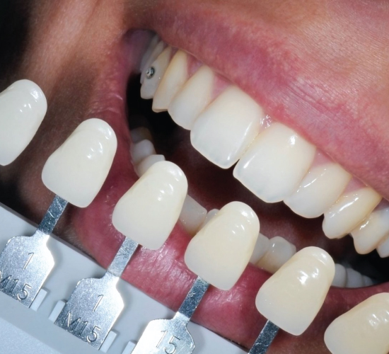 What Is Tooth-Colored Fillings? How Do Tooth-Colored Fillings Work?